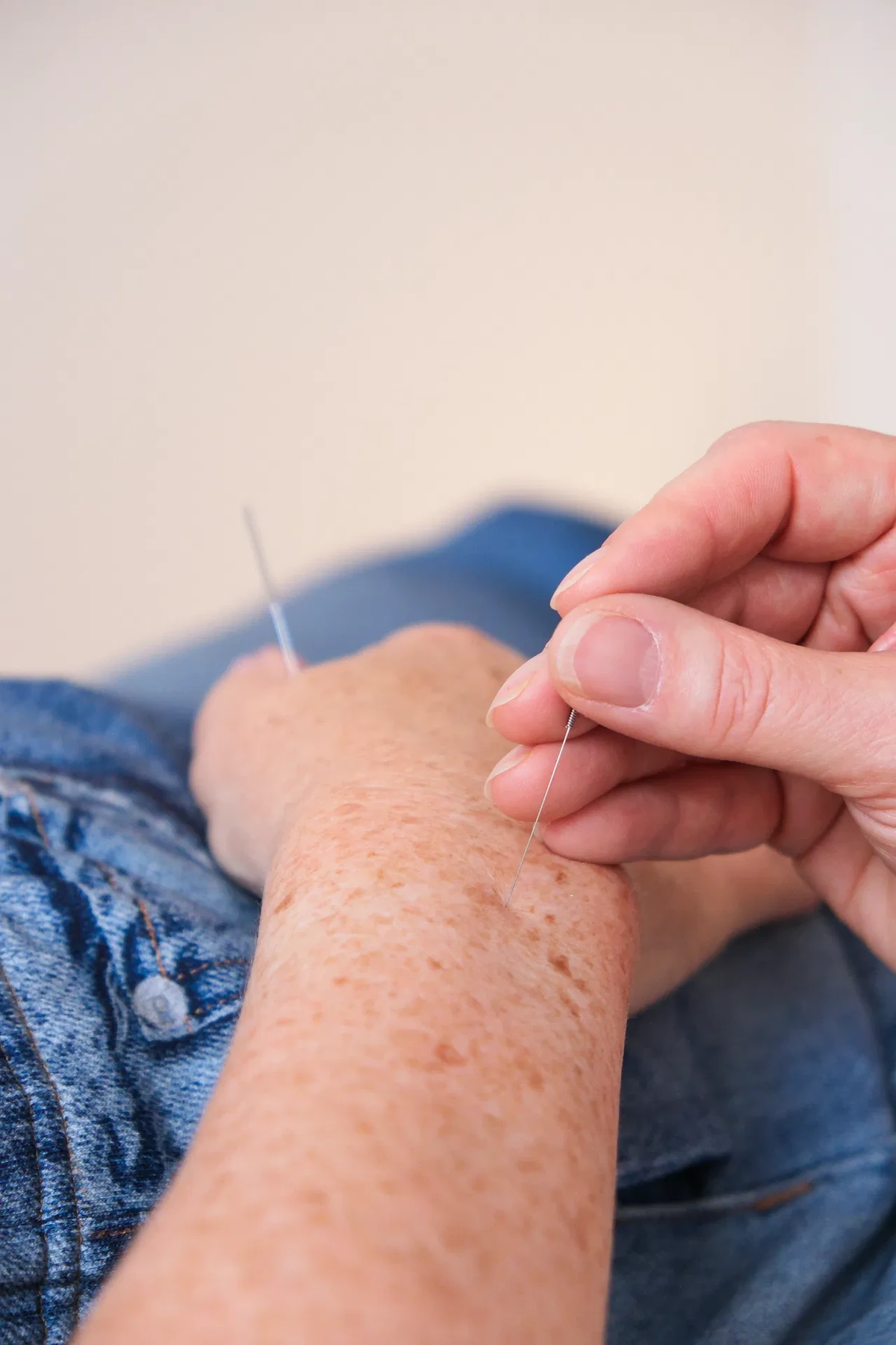 Akupunkturbehandlung am Arm in der Naturheilpraxis Isabelle Kujath in Düsseldorf